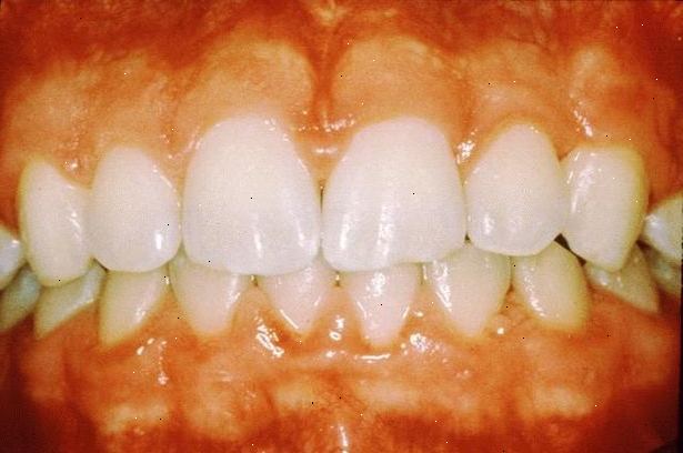 Hoe te pijnlijk tandvlees te behandelen. Raadpleeg uw tandarts.