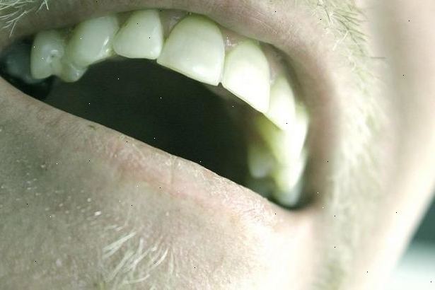 Hoe om te stoppen met slijpen je tanden. Kies wat je in je mond.