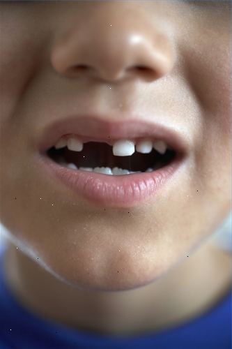 Tandenknarsen kan een vervelende en destructieve gewoonte. Train jezelf niet te tanden te knarsen.