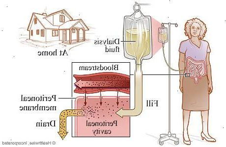 Hoe te peritoneale dialyse thuis uit te voeren. Vandaag de praktijk van peritoneale dialyse wordt in twee types.